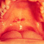 СПИД: приговор отменяется mononucleosis_body.jpg