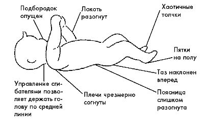 Ребенок с церебральным параличом : помощь, уход, развитие i_022.jpg