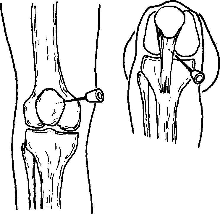 Можно в коленный сустав делать уколы