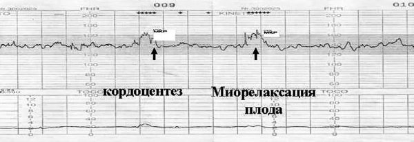 Изоиммунизация при беременности _35.jpg