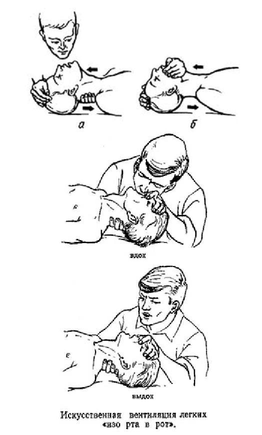 Восстановление проходимости дыхательных путей. Искусственная вентиляция легких плакат. Основы реаниматологии рисунки.